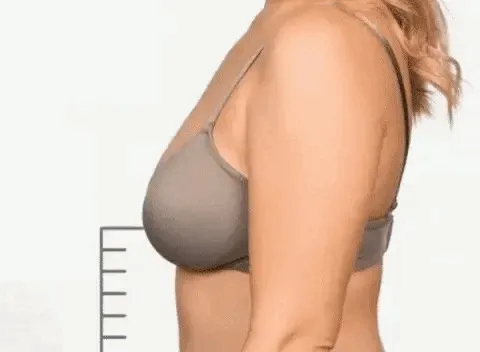Bra with front buttons